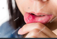 এ্যপথাস আলসার – Aphthous Ulcer